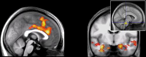 cerebro durante ansiedade e crise de panico